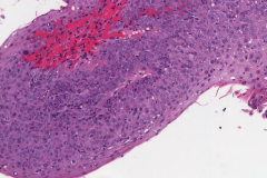 Papillary squamous cell carcinoma of the larynx