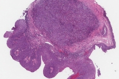 Papillary squamous cell carcinoma of the larynx