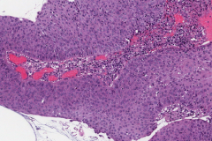 Papillary squamous cell carcinoma of the larynx