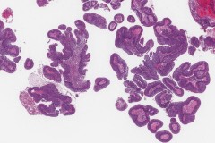 Papillary squamous cell carcinoma of the larynx