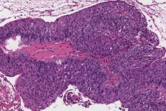 Papillary squamous cell carcinoma of the larynx