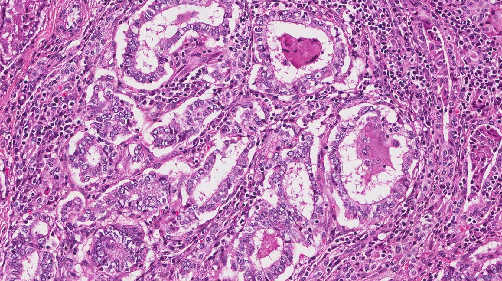 Papillary Thyroid Carcinoma 