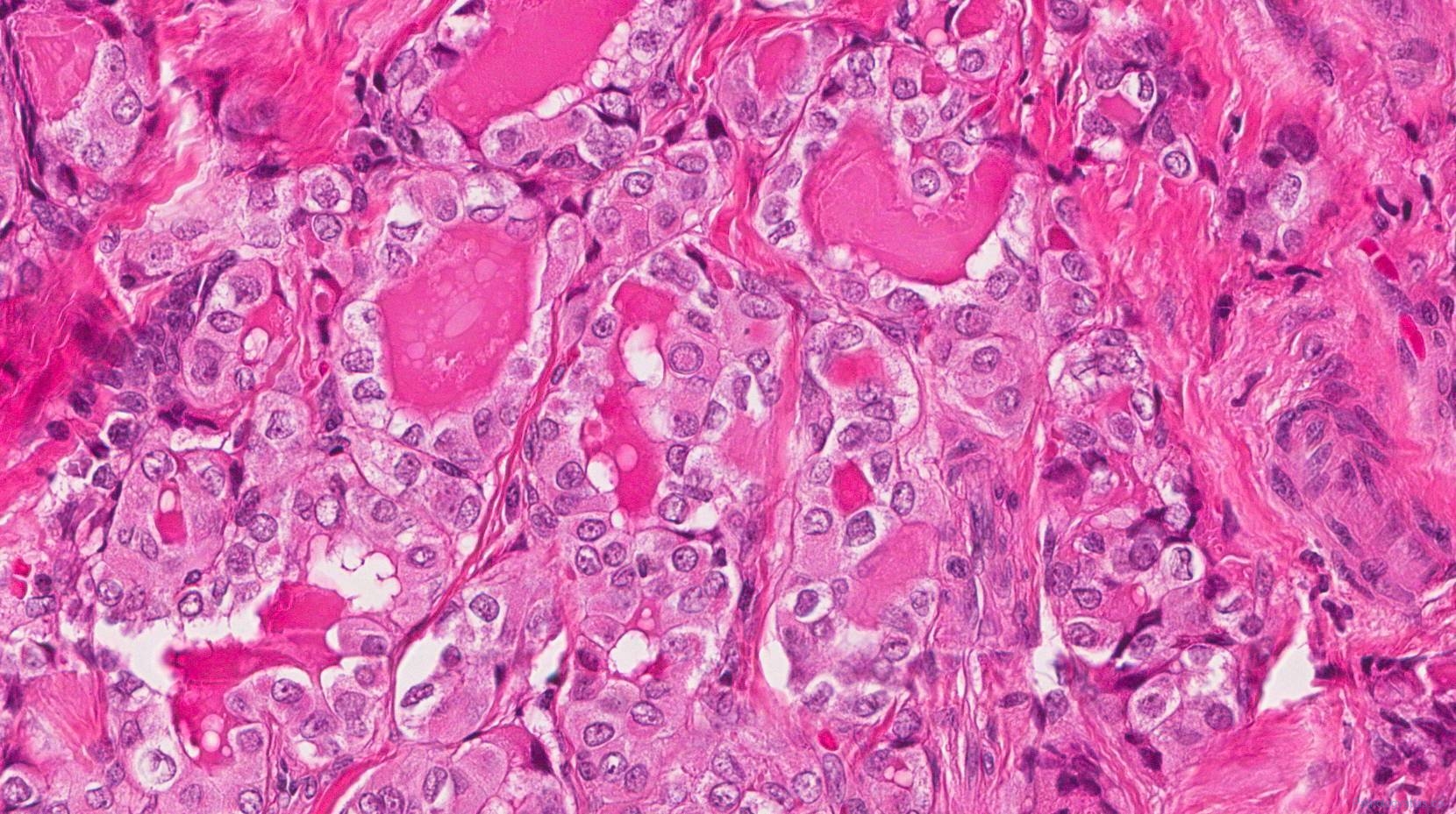 Papillary thyroid carcinoma | Ottawa Atlas of Pathology