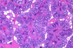 Classic variant papillary thyroid carcinoma