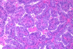 Classic variant papillary thyroid carcinoma