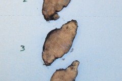 Diffuse sclerosing variant papillary thyroid carcinoma