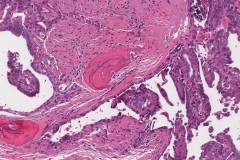 Papillary thyroid carcinoma with osseous differentiation