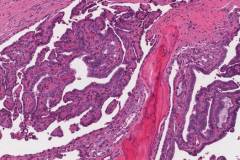 Papillary thyroid carcinoma with osseous differentiation