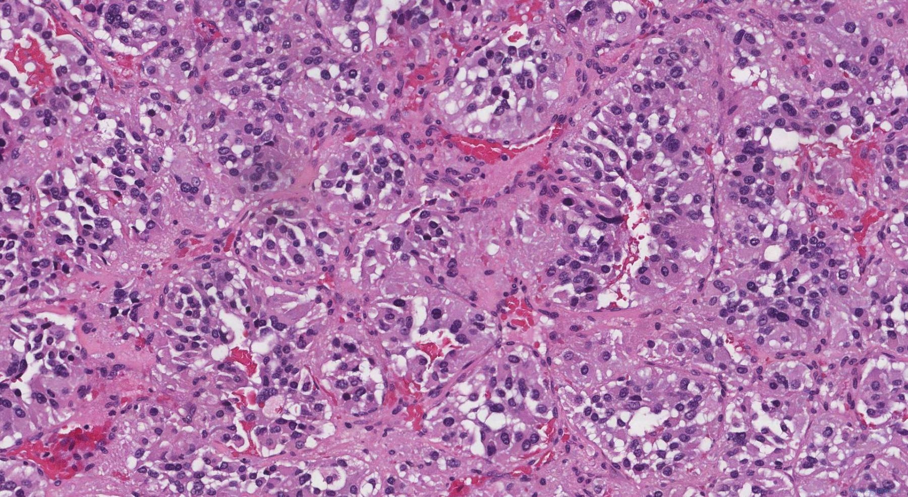 Paraganglioma | Atlas of Pathology