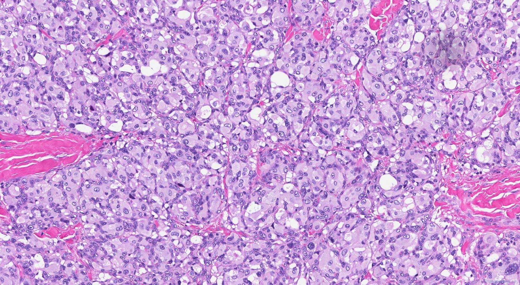 Paraganglioma | Atlas of Pathology