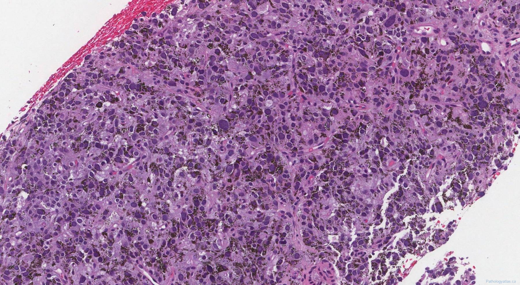 Paraganglioma | Atlas of Pathology