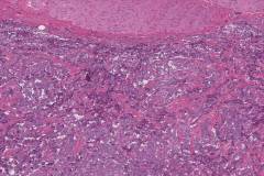 Paraaortic paraganglioma