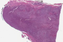 Paraaortic paraganglioma