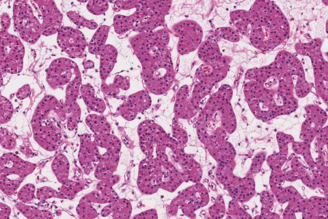 Parathyroid adenoma | Atlas of Pathology