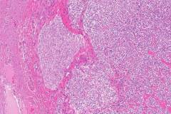 Perivascular epithelioid cell tumour of the uterus