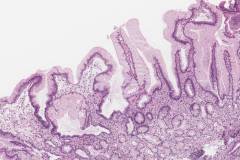 Peptic duodenitis: Foveolar metaplasia