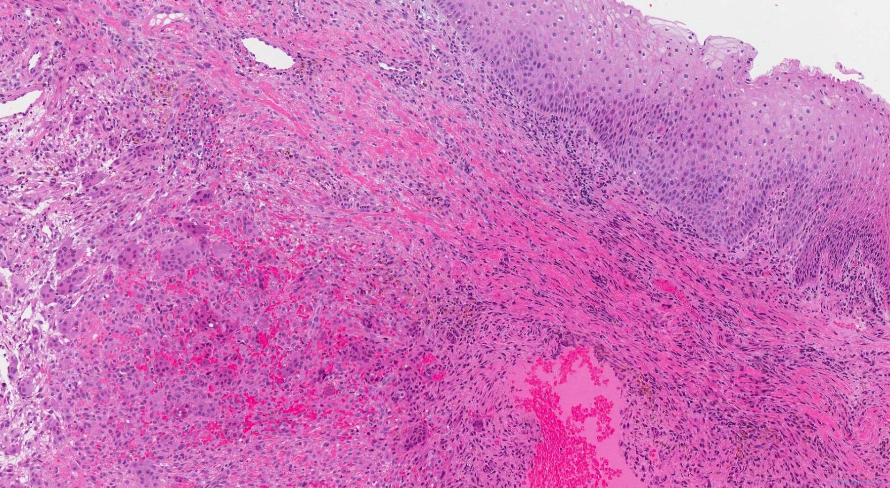 Peripheral Giant Cell Granuloma Atlas Of Pathology