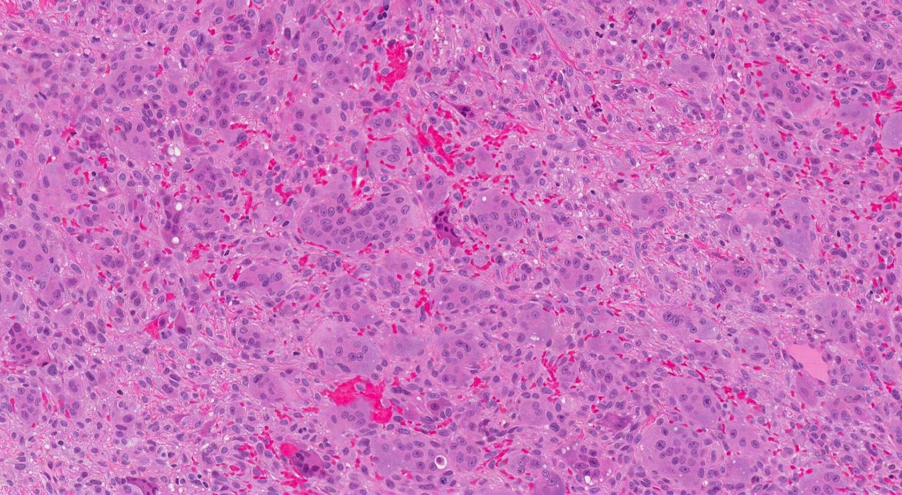 Peripheral giant cell granuloma | Ottawa Atlas of Pathology