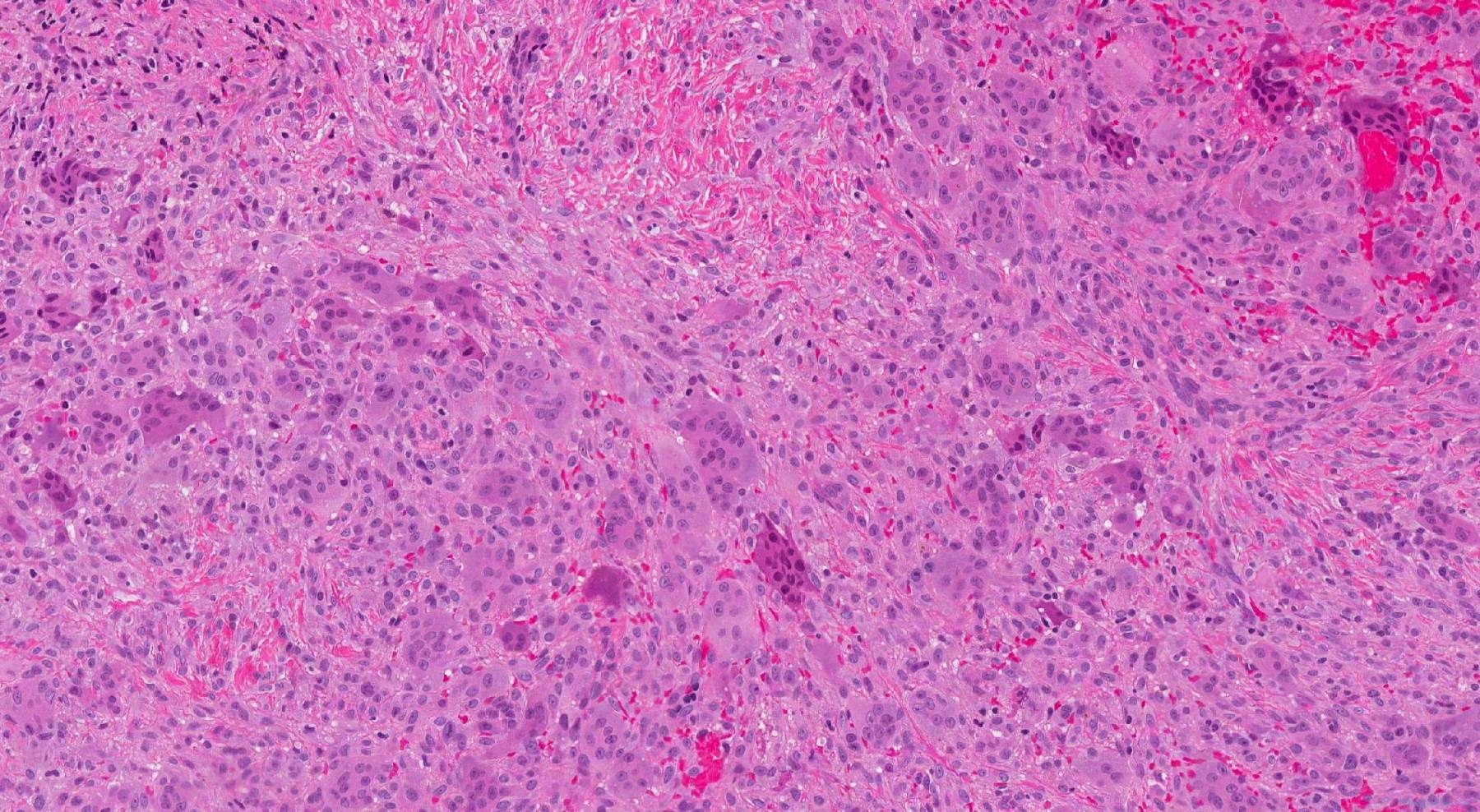 Peripheral giant cell granuloma | Atlas of Pathology