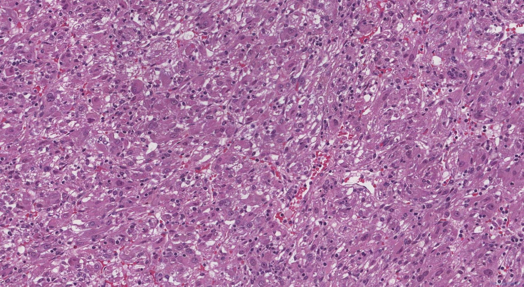 Perivascular epithelioid cell tumour of the liver | Atlas of Pathology