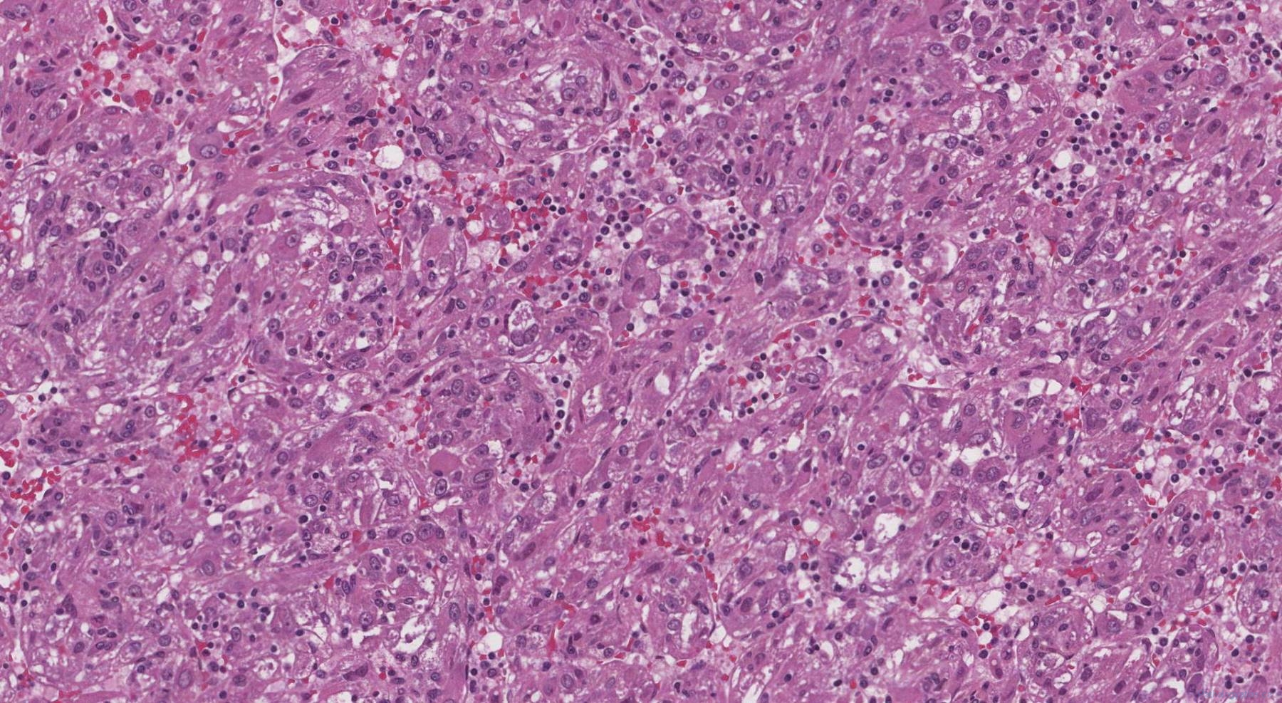 Perivascular epithelioid cell tumour of the liver | Atlas of Pathology