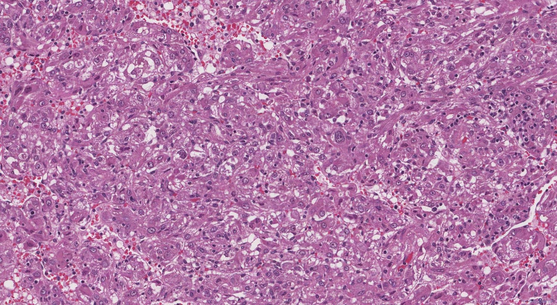 Perivascular epithelioid cell tumour of the liver | Atlas of Pathology