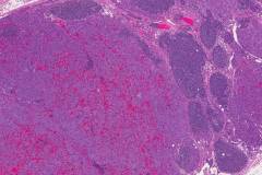 Metastatic pheochromocytoma to a lymph node