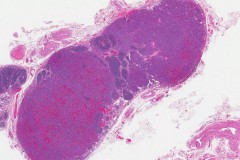 Metastatic pheochromocytoma to a lymph node