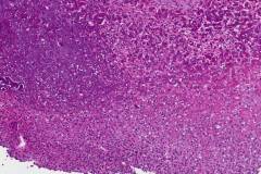 Phosphaturic mesenchymal tumour