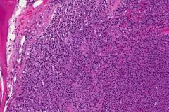 Plasma cell myeloma in a patient with multiple myeloma