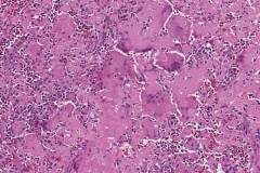 Amyloidoma of a lymph node secondary to multiple myeloma