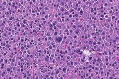 Plasma cell neoplasm in bone