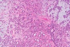 Pleomorphic adenoma