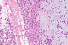 Pleomorphic adenoma