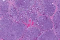 Pleomorphic adenoma