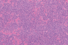 Pleomorphic adenoma