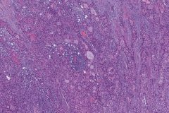 Pleomorphic adenoma