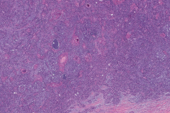 Pleomorphic adenoma