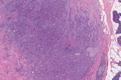 Pleomorphic adenoma