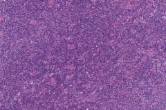 Pleomorphic adenoma