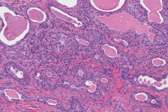 Pleomorphic adenoma