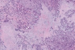 Pleomorphic adenoma