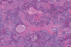 Pleomorphic adenoma