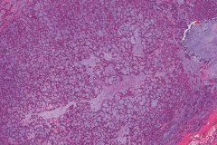 Pleomorphic adenoma