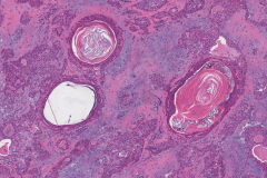 Pleomorphic adenoma