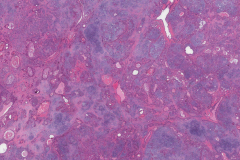 Pleomorphic adenoma