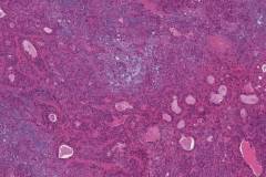 Pleomorphic adenoma with a PLAG-CTNNB1 fusion