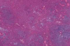 Pleomorphic adenoma with a PLAG-CTNNB1 fusion