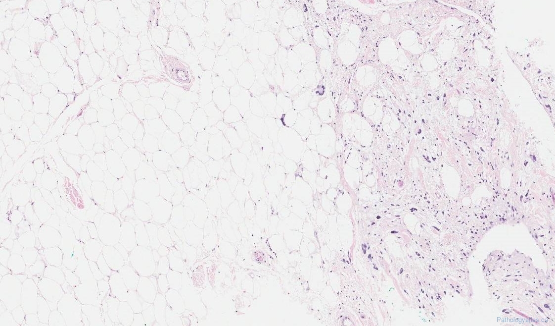 Pleomorphic lipoma | Atlas of Pathology