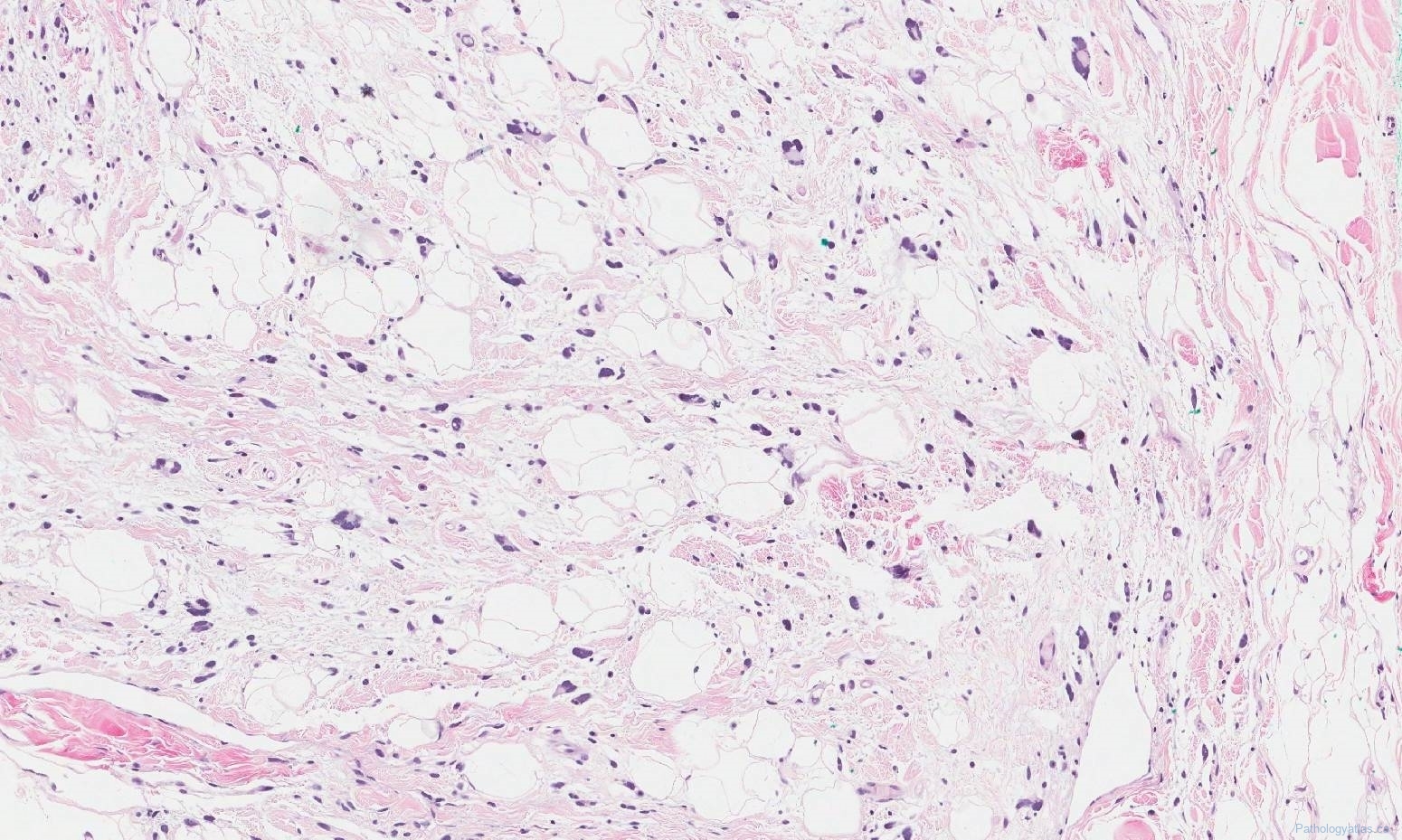 Pleomorphic lipoma | Atlas of Pathology